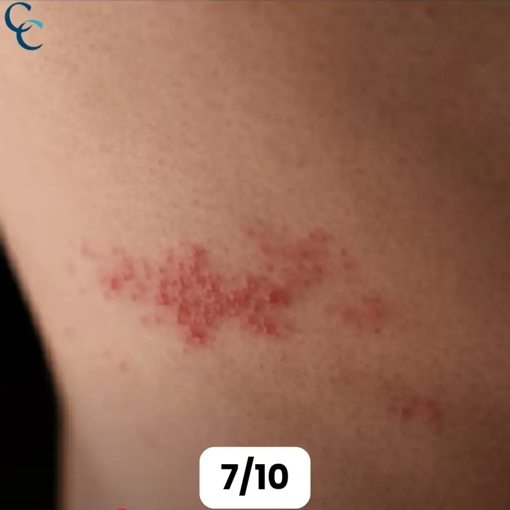 Genital Herpes Pictures, Symptoms, and Treatment - Confident Care